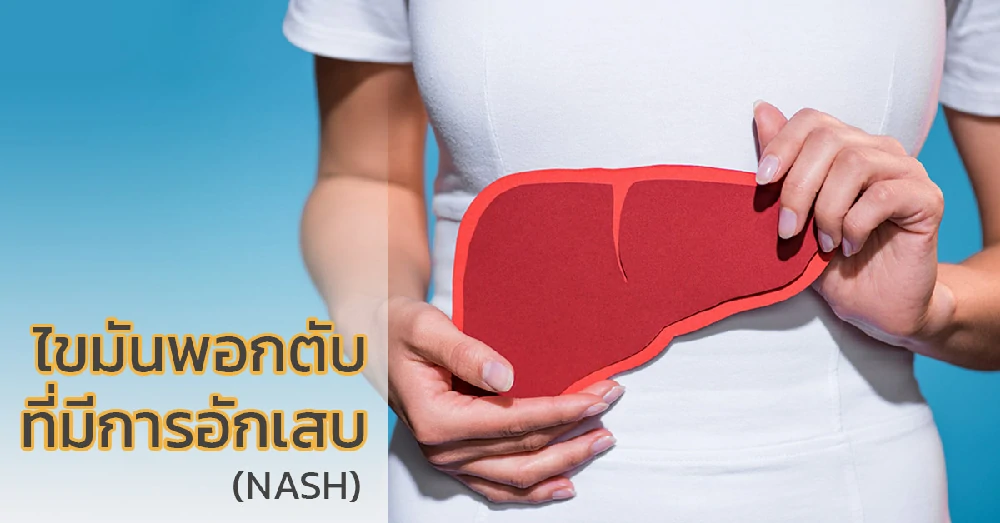 ไขมันพอกตับที่มีการอักเสบร่วมด้วย (NASH)