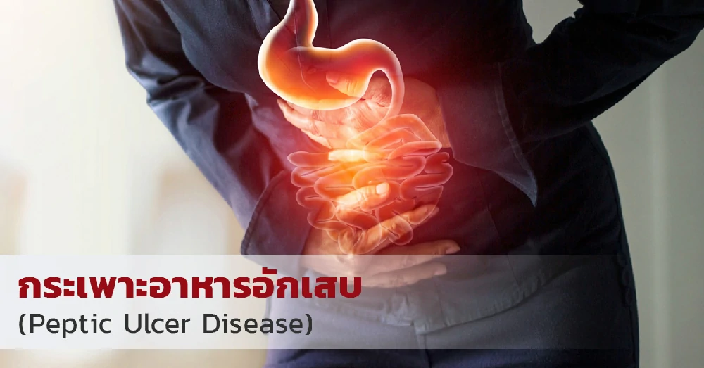 กระเพาะอาหารอักเสบ (Peptic Ulcer Disease)