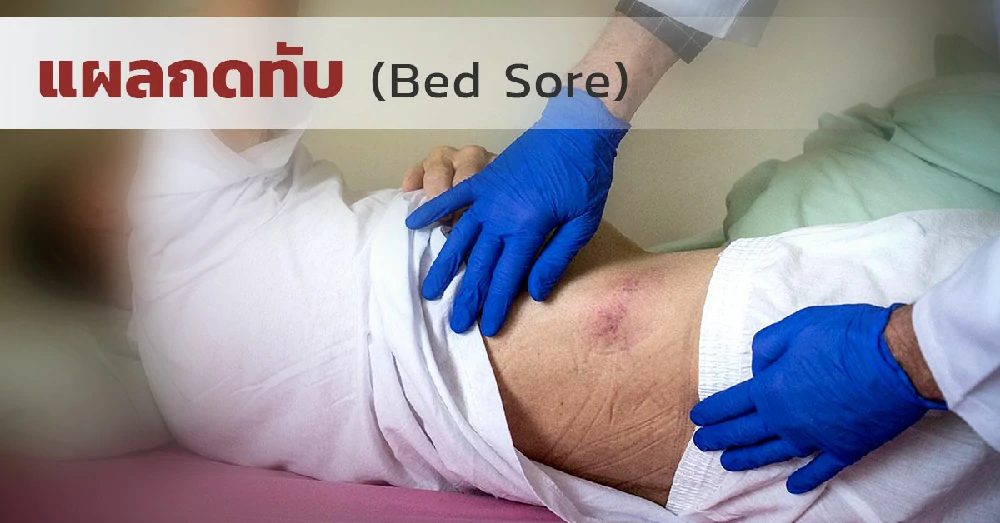 แผลกดทับ (Bed Sore)