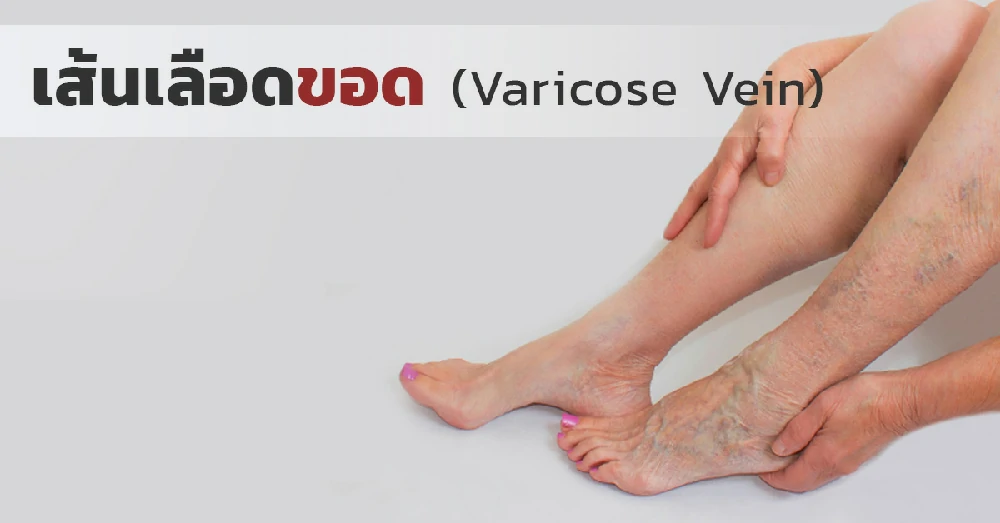 เส้นเลือดขอด (Varicose Vein)
