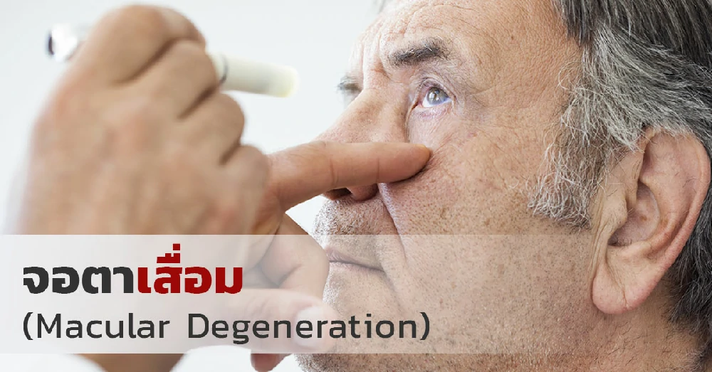 จอประสาทตาเสื่อม (Macular Degeneration)
