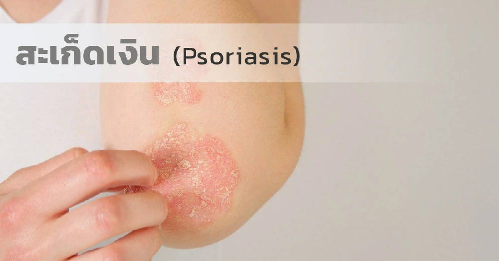 สะเก็ดเงิน (Psoriasis)