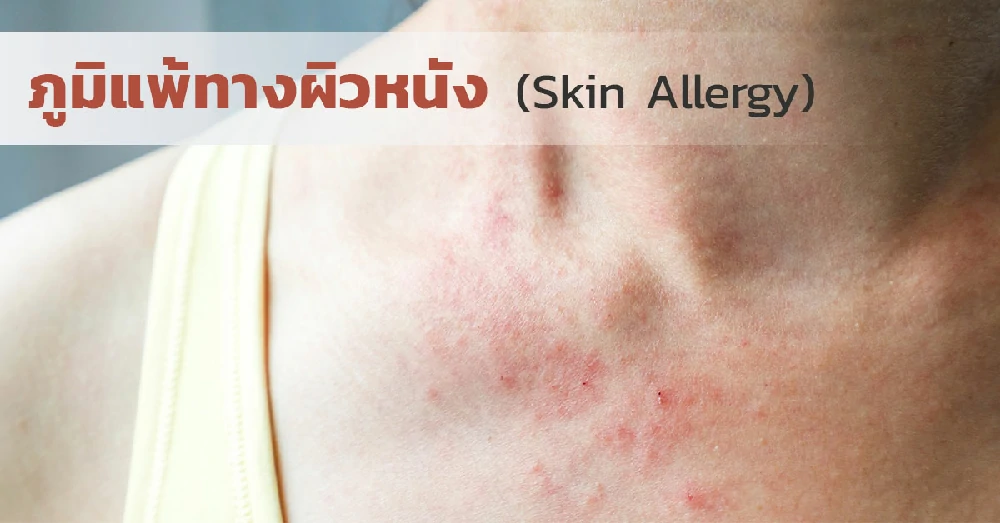 ภูมิแพ้ทางผิวหนัง (Skin Allergy)