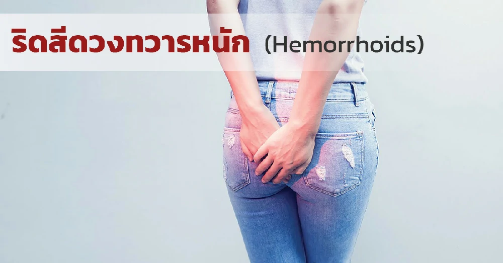 ริดสีดวงทวารหนัก (Hemorrhoids)