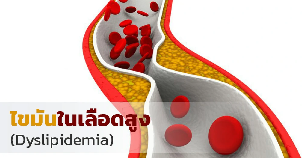 ไขมันในเลือดสูง (Dyslipidemia)