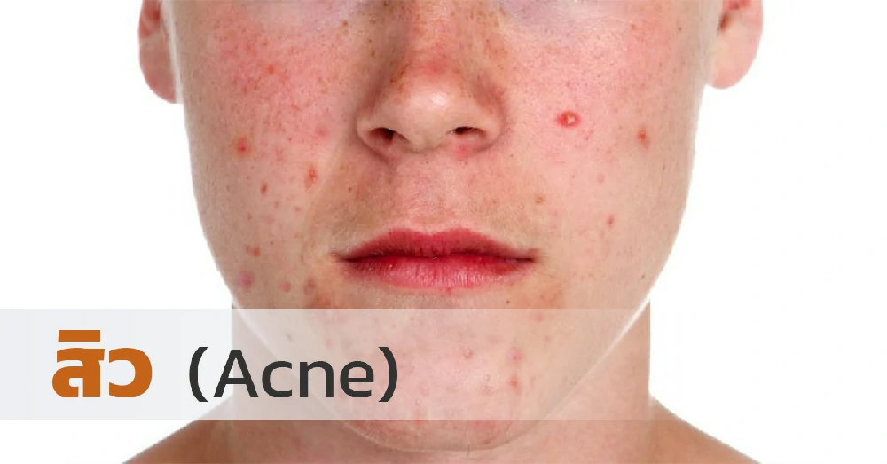 สิว (Acne)