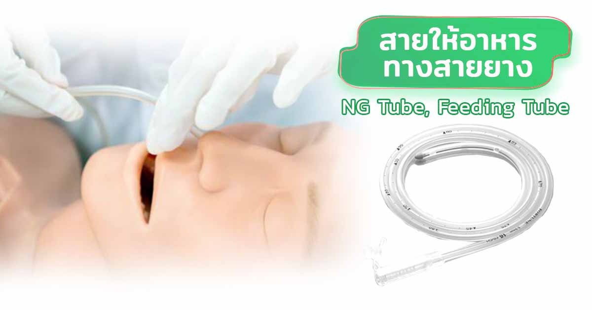 สายให้อาหารทางสายยาง (NG Tube, Feeding Tube)