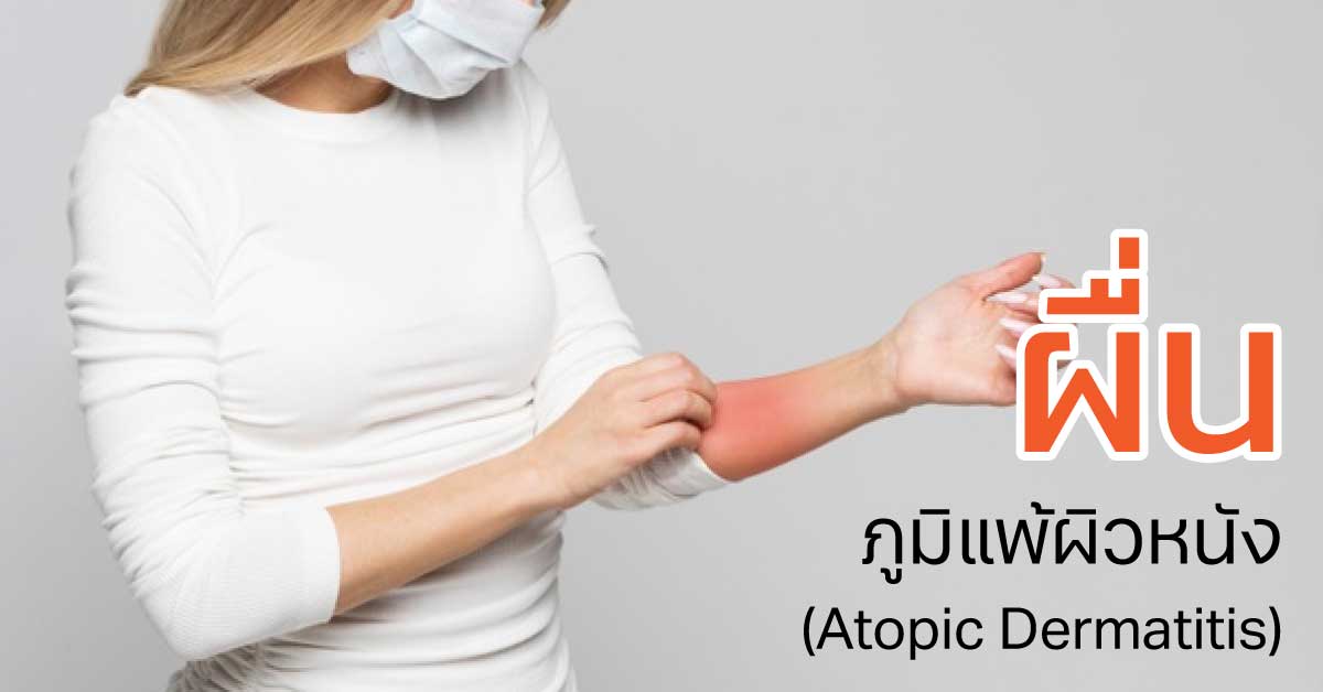 ผื่นภูมิแพ้ผิวหนัง (Atopic Dermatitis) 